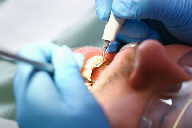 Best Emergency Wisdom Tooth Extraction in West Point, VA
