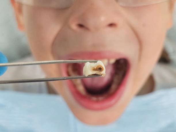 Best Broken or Chipped Tooth Repair in West Point, VA